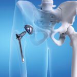 Hip Replacement Hospital in Thane: Understanding Surgical Care, Recovery, and Patient Support
